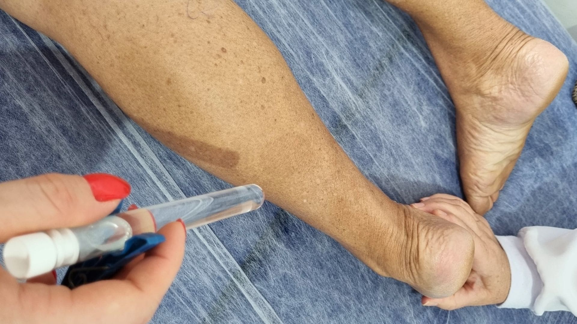 Prefeitura de Água Boa realiza ação de prevenção à Hanseníase